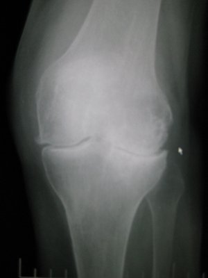 Osteoarthritis-left-knee The first test you can expect is an x-ray of your knee which is taken from various angles to provide an accurate visualization of the damage in your joint. If the physician suspects damage to ligaments or a meniscus, you may also undergo an MRI (Magnetic Resonance Imaging).