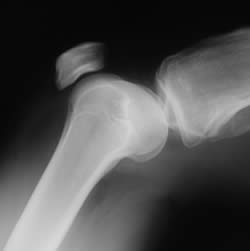 orthopedics_250x251 Sometimes, when the inevitable path to increased disability is apparent, an orthopedic surgeon may suggest that you have this surgery sooner than later for a variety of reasons. Don’t wait until you are knee deep in trouble to seek advice. Do it today!